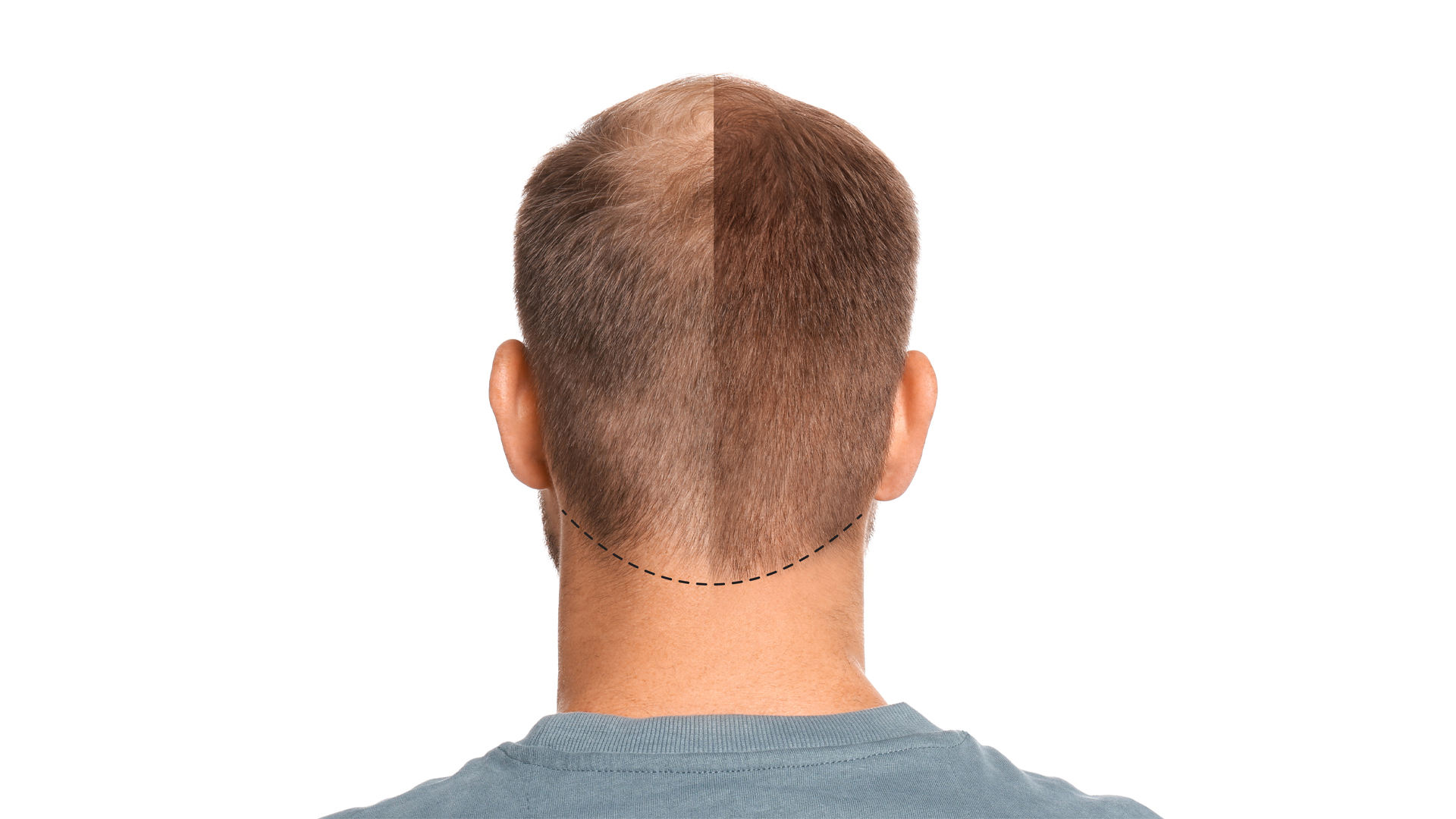 Hair Transplant